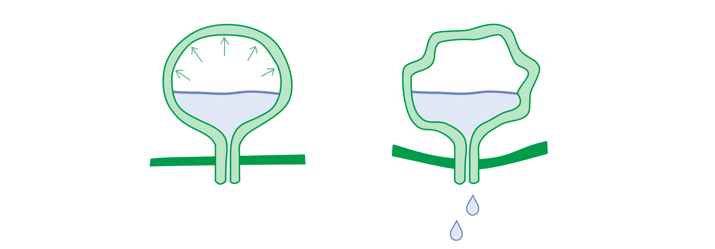 illustrations of weakened bladder muscles which can lead to incontinence