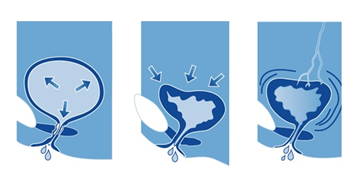 loss of bladder control