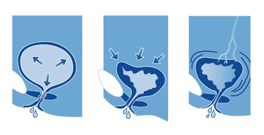 loss of bladder control