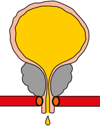 Überlaufinkontinenz