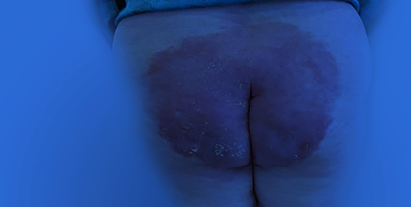 L'effet de l'urine sur la peau