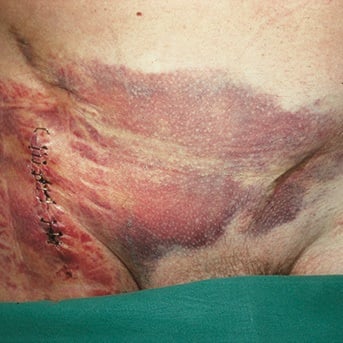 Ausgedehntes Wundhämatom