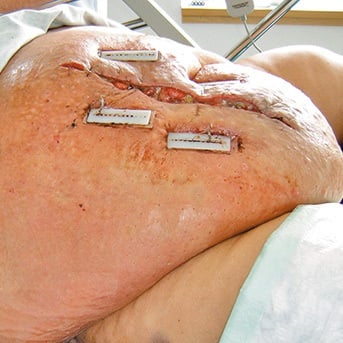Wunddehiszenz bei Patient mit massiver Adipositas