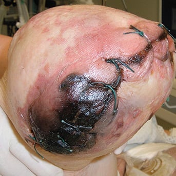 Ausgedehnte Wundrand- und Weichteilnekrose