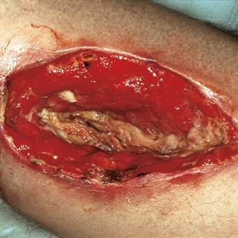 Komplette Ruptur mit Muskelnekrose nach einer Bypass-Operation im Knie