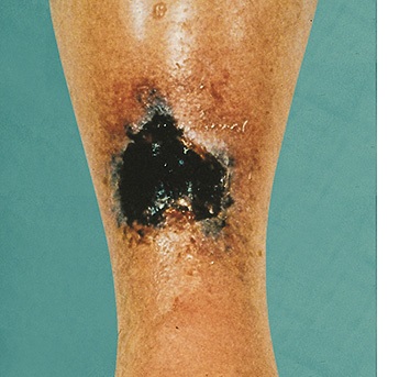 Ulcus cruris arteriosum