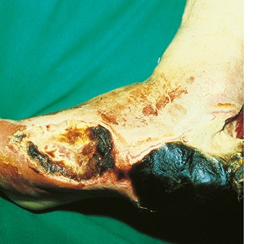 Diabetisches Ulkus / angiopathisch