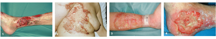 Composing Exsudatfluss