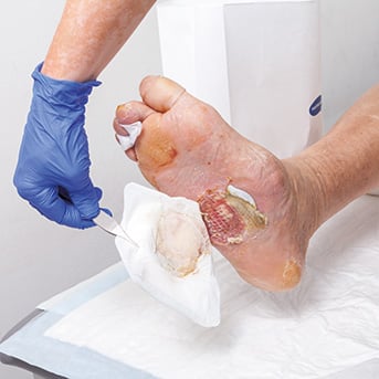 Verbandwechsel am Fuss