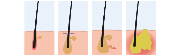 Acne Inversion Erfolgreiche Wundbehandlung bei Acne inversa | HARTMANN