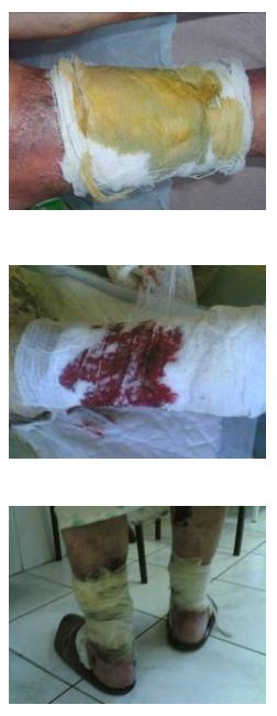 Wound-Dressing-Bandage