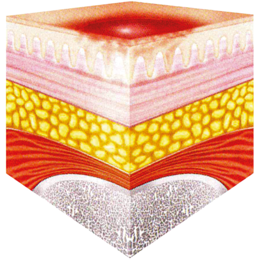 Wunddokumentation Dekubitus Kategorie I
