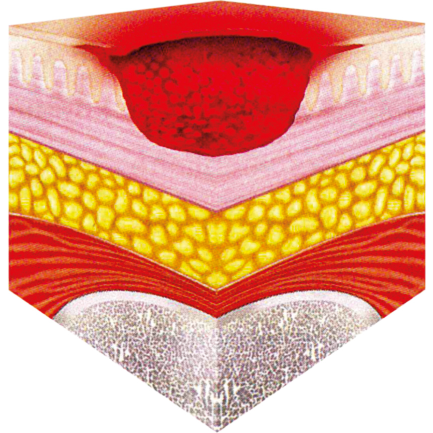 Wunddokumentation Dekubitus Kategorie II
