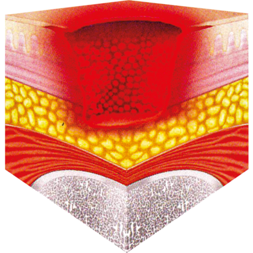Wunddokumentation Dekubitus Kategorie III