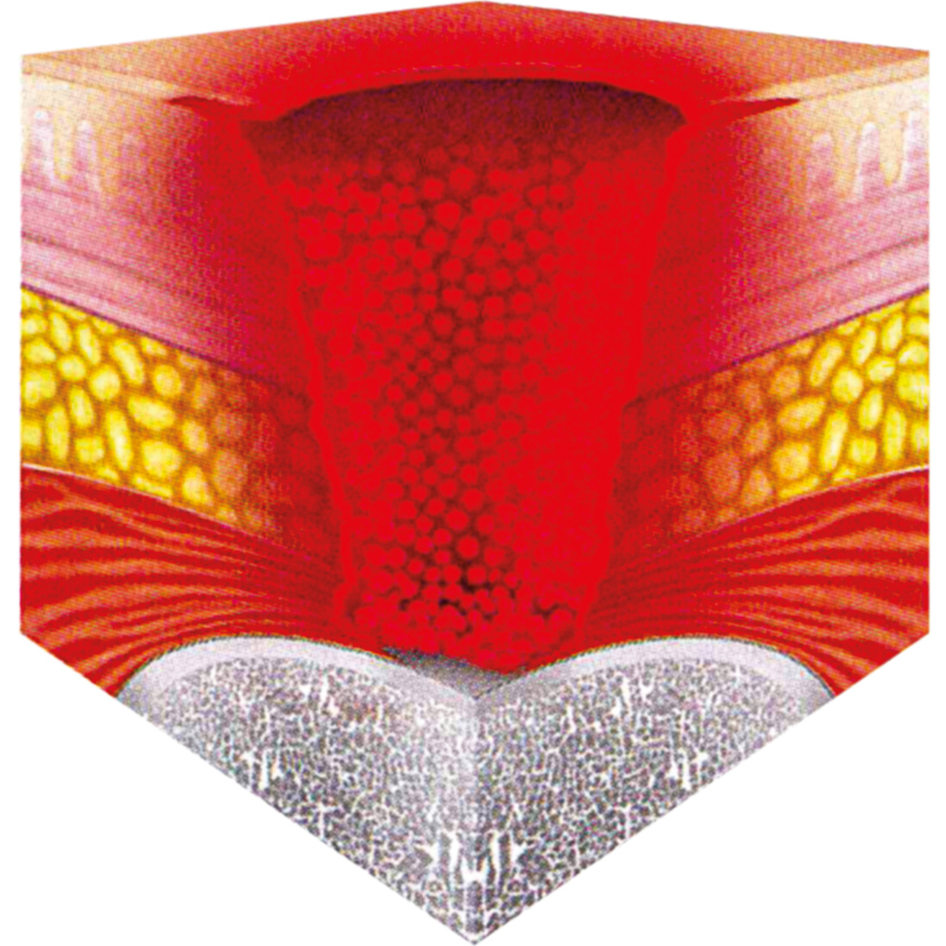Wunddokumentation Dekubitus Kategorie IV