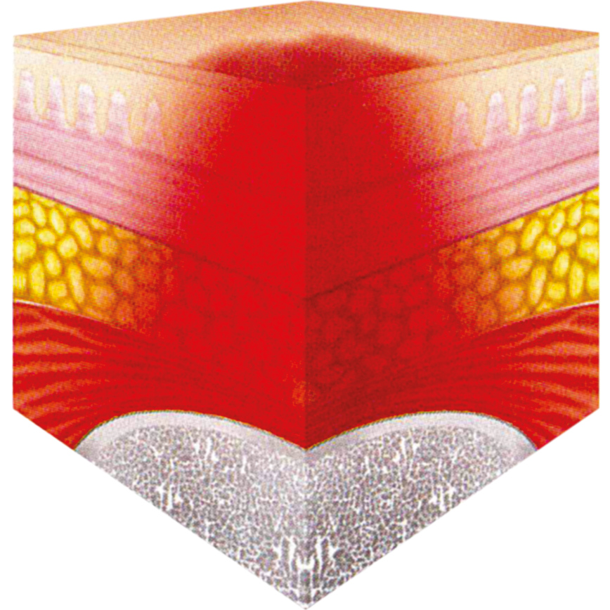 Wunddokumentation Dekubitus zusätzliche Kategorie 