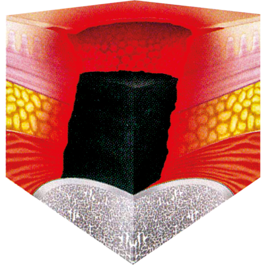 Wunddokumentation Dekubitus zusätzliche Kategorie