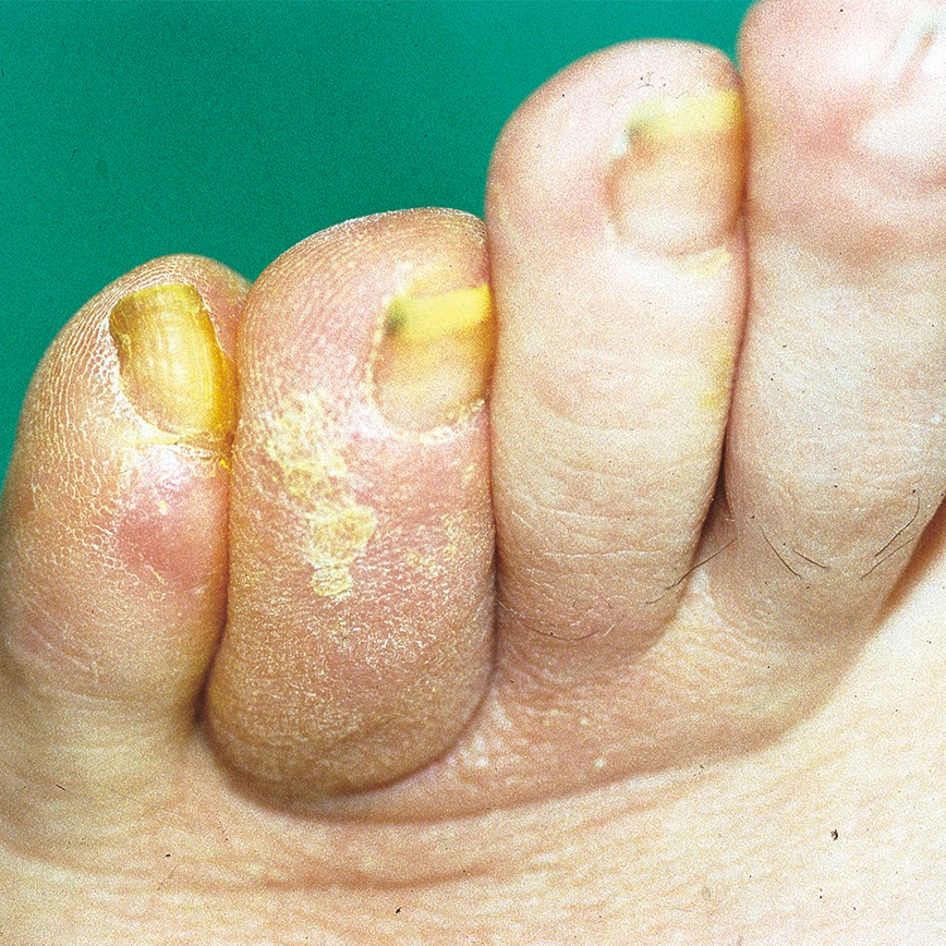 Wunddokumentation Diabetisches Fußulcus nach Wagner Grad 0