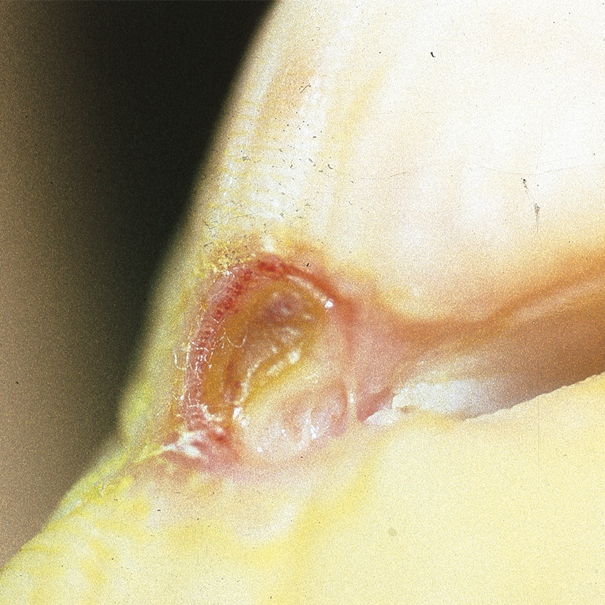 Wunddokumentation Diabetisches Fußulcus nach Wagner Grad 1