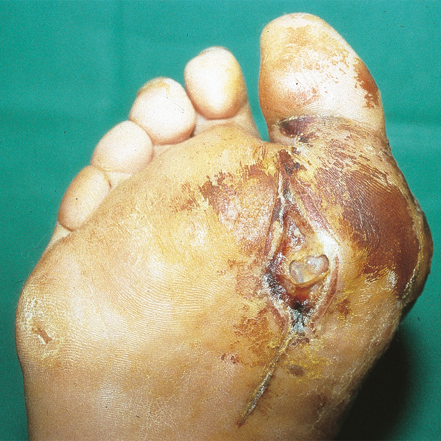 Wunddokumentation Diabetisches Fußulcus nach Wagner Grad 2