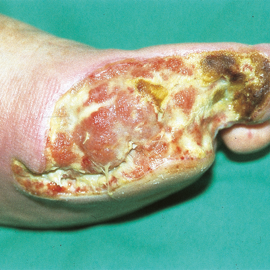 Wunddokumentation Diabetisches Fußulcus nach Wagner Grad 3