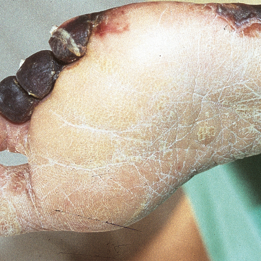 Wunddokumentation Diabetisches Fußulcus nach Wagner Grad 4