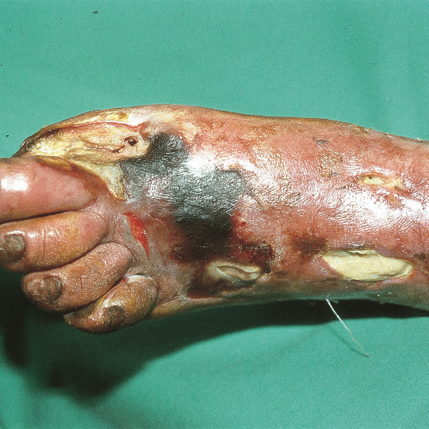 Wunddokumentation Diabetisches Fußulcus nach Wagner Grad 5