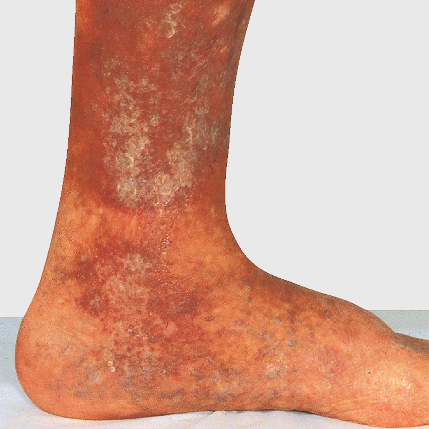 Wunddokumentation Ulcus cruris nach Widmer Grad I