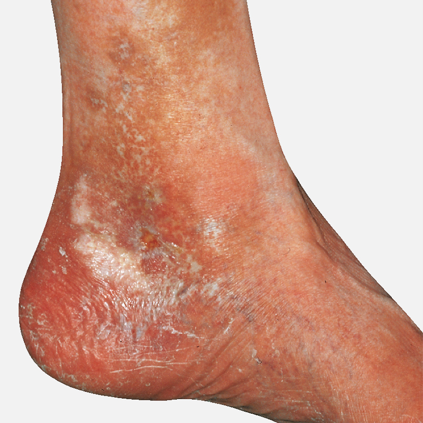 Wunddokumentation Ulcus cruris nach Widmer Grad II