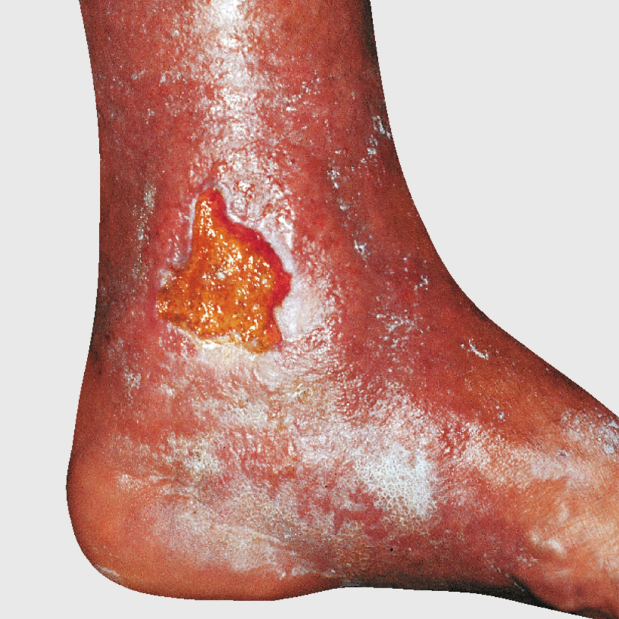 Wunddokumentation Ulcus cruris nach Widmer Grad III