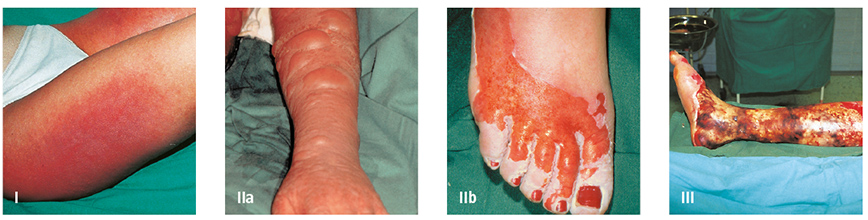 Wunddokumentation Verbrennungen
