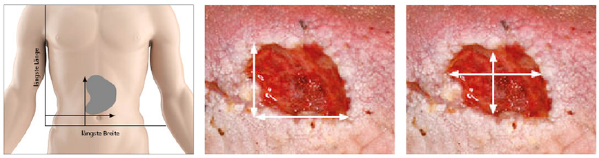 Wunddokumentation Wundgröße nach Körperachse
