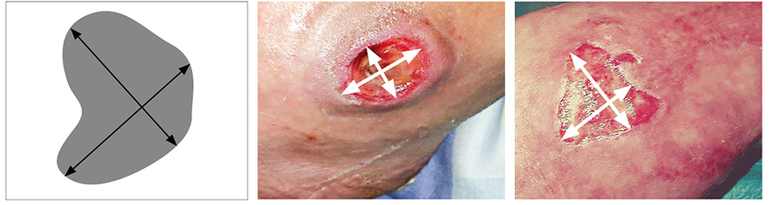 Wunddokumentation Wundgröße Perpendiculare Bestimmung