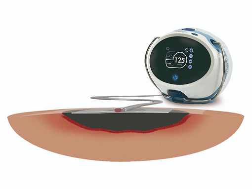 Vivano®: Systém podtlakové terapie Bezpečně a jednoduše