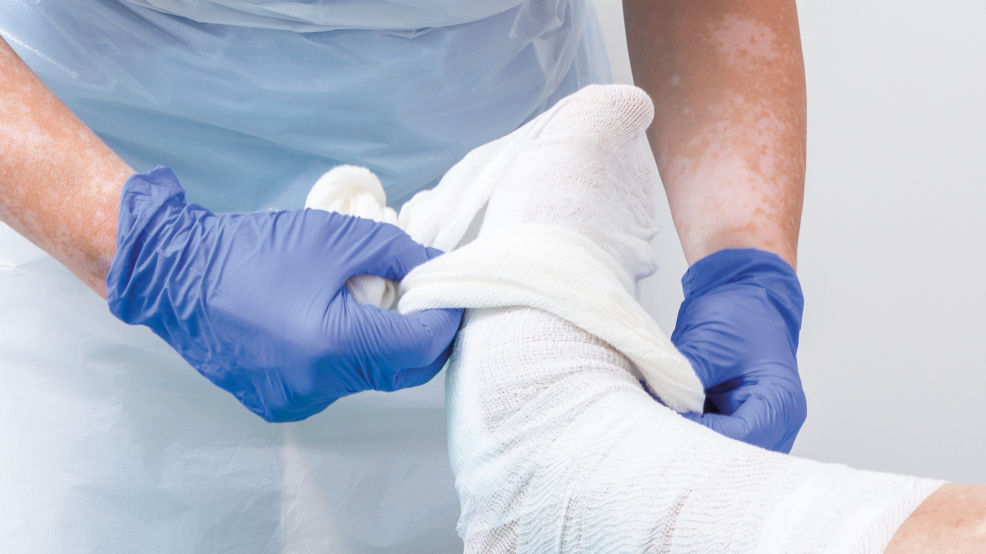  A medical professional in blue gloves carefully wraps a foot with a white bandage, focusing on precision and care for optimal healing.