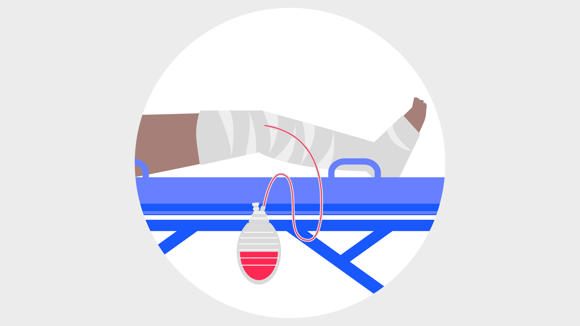 Illustration of the wound drain method