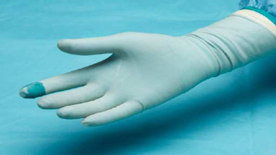 Nahaufnahme eines sterilen medizinischen Handschuhs nach einer Punktion