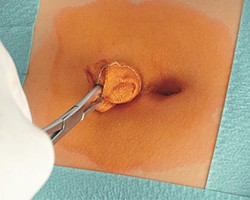 Dezinfekcia kože pred chirurgickým zákrokom prostriedkom od HARTMANN