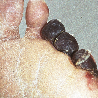 Angiopathisch-ischämischer Fuß 