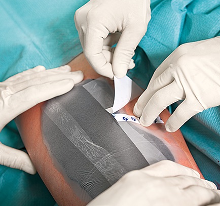 A surgical team is operating a chronical wound